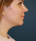 Feel Beautiful - Necklift 204 - Before Photo